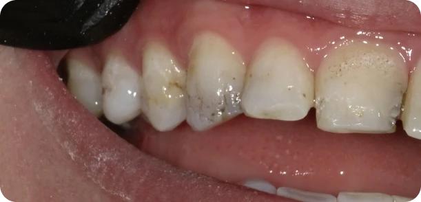 Bonding example, before treatment: close view of a front tooth