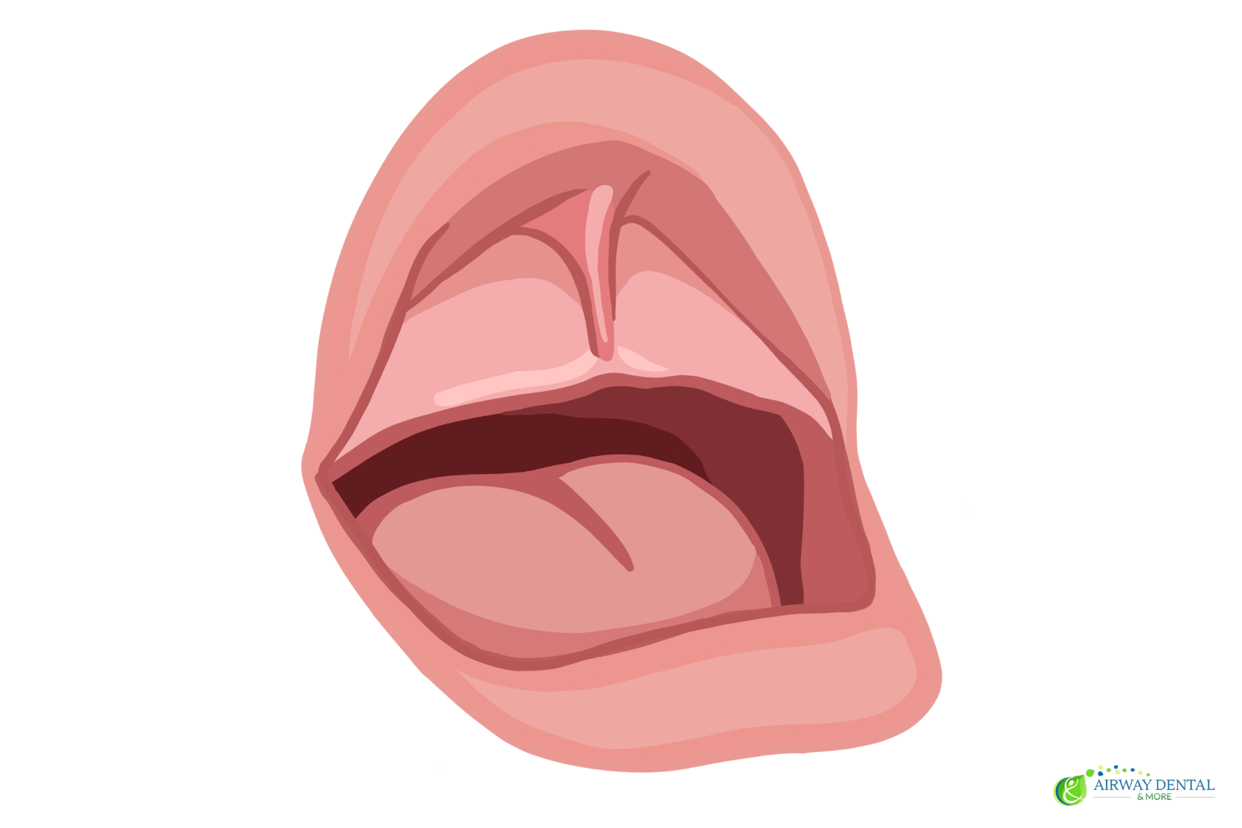 Illustration of tissue connecting the upper lip and gum