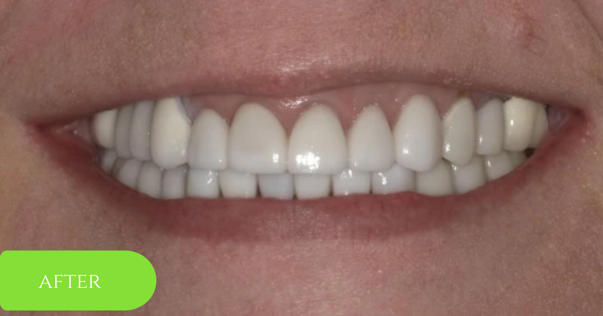 Full smile makeover example, after treatment: teeth shown while smiling