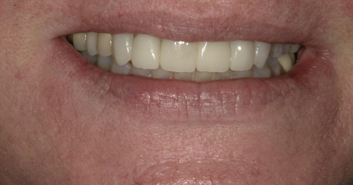 Veneers example, after treatment: front teeth shown while smiling