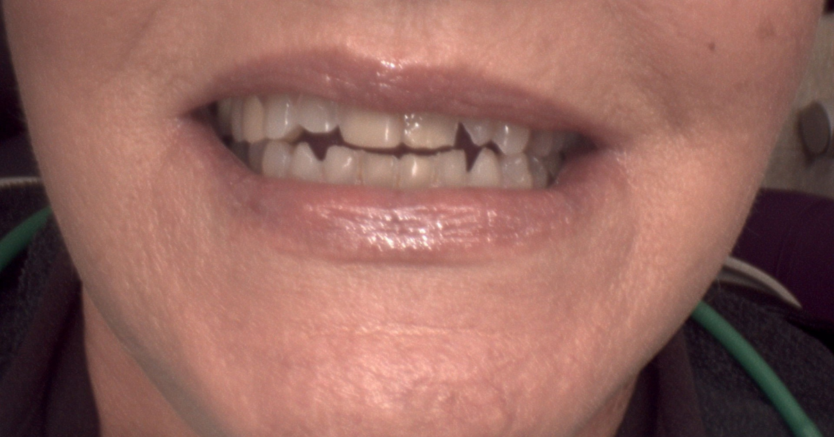 Veneers example, before treatment: front teeth shown while smiling